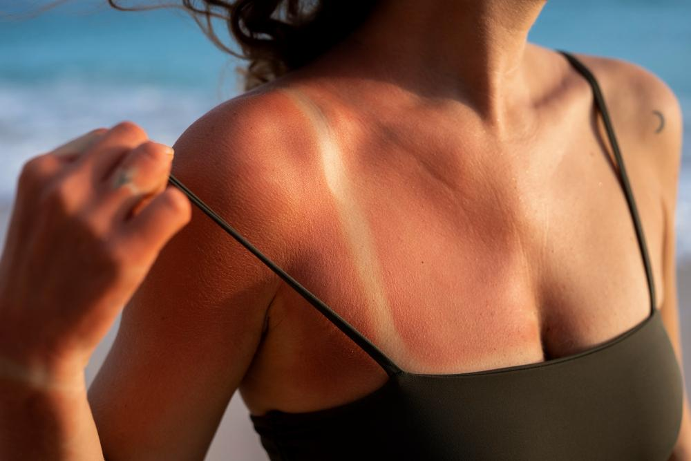 Pet korakov za obnovo opečene kože